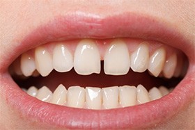 A person with gapped front teeth.