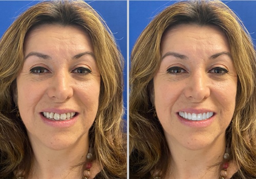 simulation of woman’s teeth becoming whiter and straighter