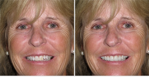 simulated preview of older woman’s straighter, brighter smile