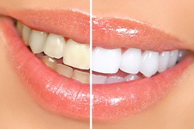 Up-close view of stained and brighter teeth