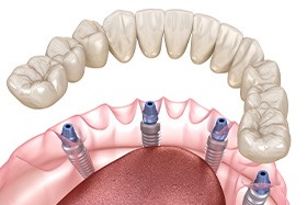 All-on-4 dentures