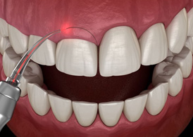 Illustration of laser being used for gum contouring