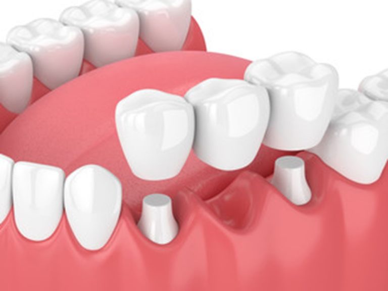 What To Do If Your Dental Bridge Falls Out Juno Beach Smiles