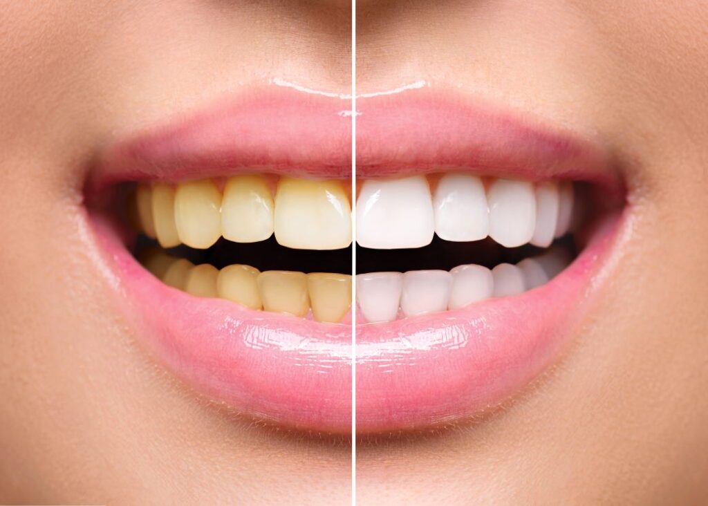 A woman’s smile before and after professional teeth whitening.